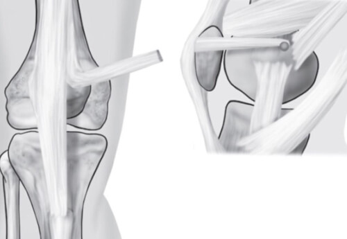 Cirurgia De Reconstrução Do Ligamento Patelofemoral Medial Redcimensionado