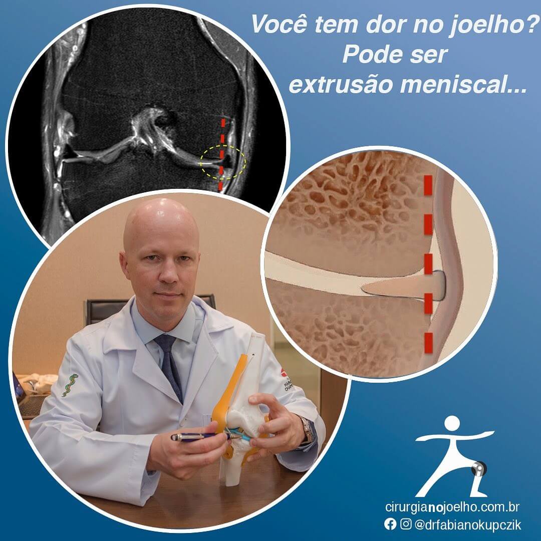 Voce Tem Dor No Joelho Pode Ser Extrusao Meniscal