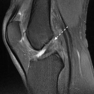Ressonância Magnética Do Joelho. Lesão Proximal Do LCA Ideal Para Realização Da Reparação