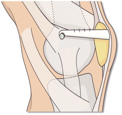 Reconstrução do ligamento patelofemoral medial com enxerto do tendão patelar. LIVRO 2 Reconstrução do ligamento patelofemoral medial com enxerto do tendão-patelar