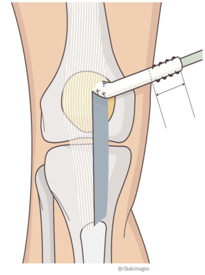 Reconstrução do ligamento patelofemoral medial com enxerto do tendão patelar. LIVRO Reconstrução do ligamento patelofemoral medial com enxerto do tendão-patelar