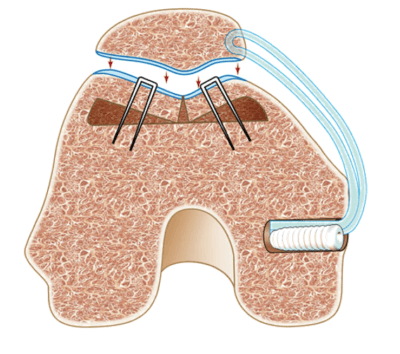 Trocleoplastia associada à reconstrução do ligamento patelofemoral medial (LPFM)